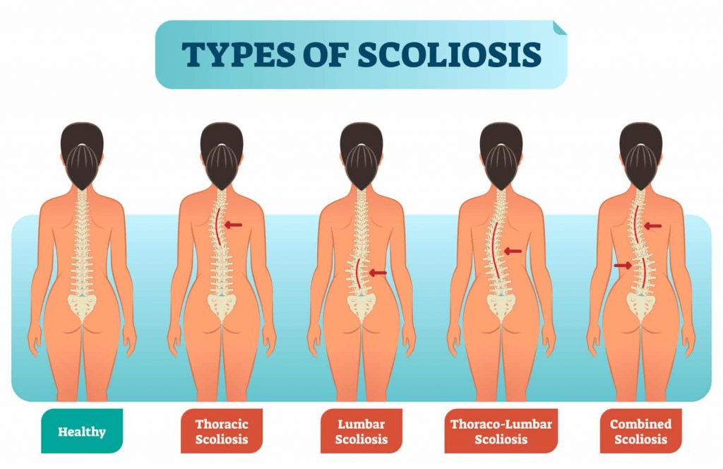 Scoliosi correlazione con piede